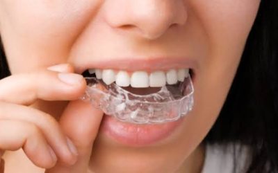 Invisalign image