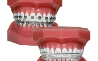 damon vs ceramic braces image