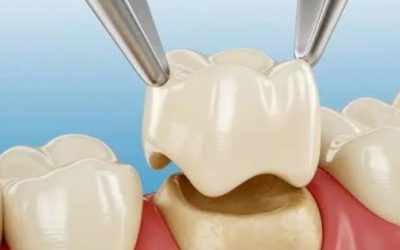 dental crown image