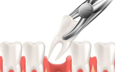 tooth extraction image